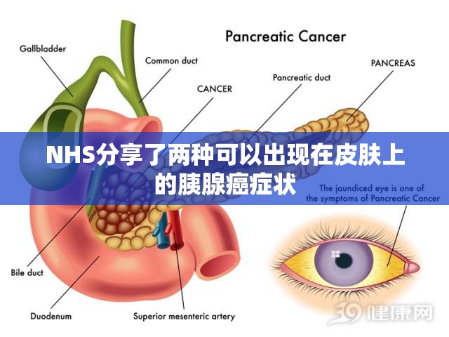 NHS分享了两种可以出现在皮肤上的胰腺癌症状